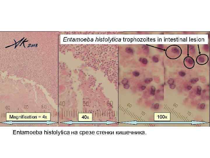 Entamoeba histolytica на срезе стенки кишечника. 