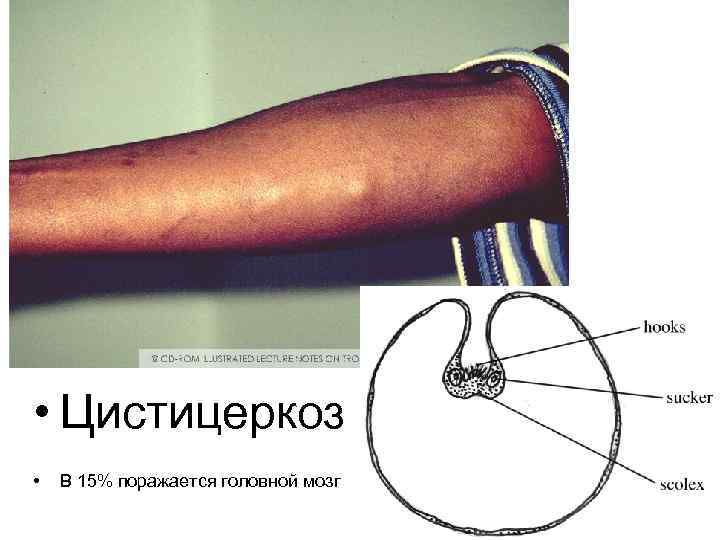  • Цистицеркоз • В 15% поражается головной мозг 