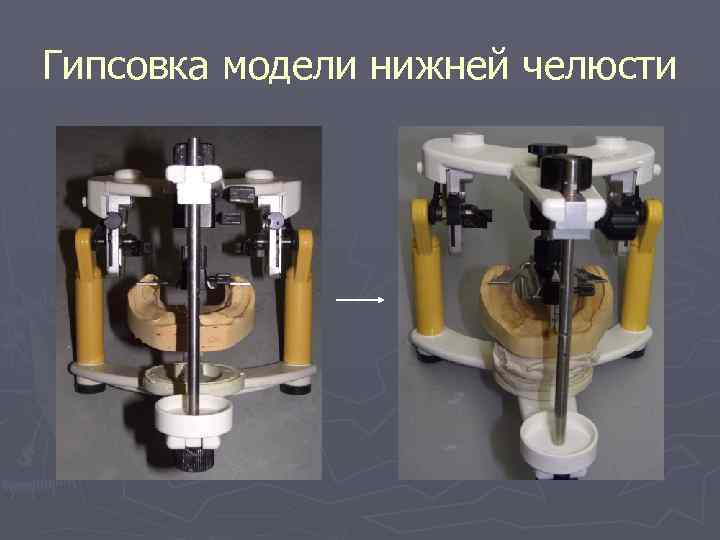 Гипсовка модели нижней челюсти 