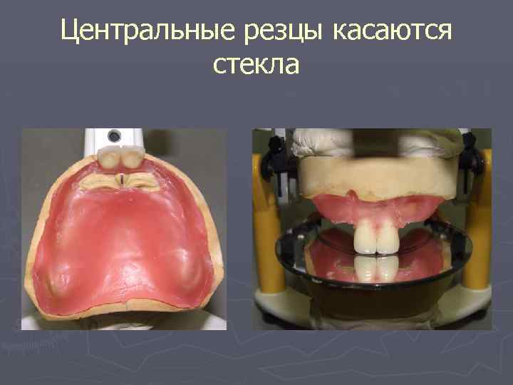 Центральные резцы касаются стекла 