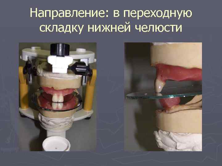 Направление: в переходную складку нижней челюсти 