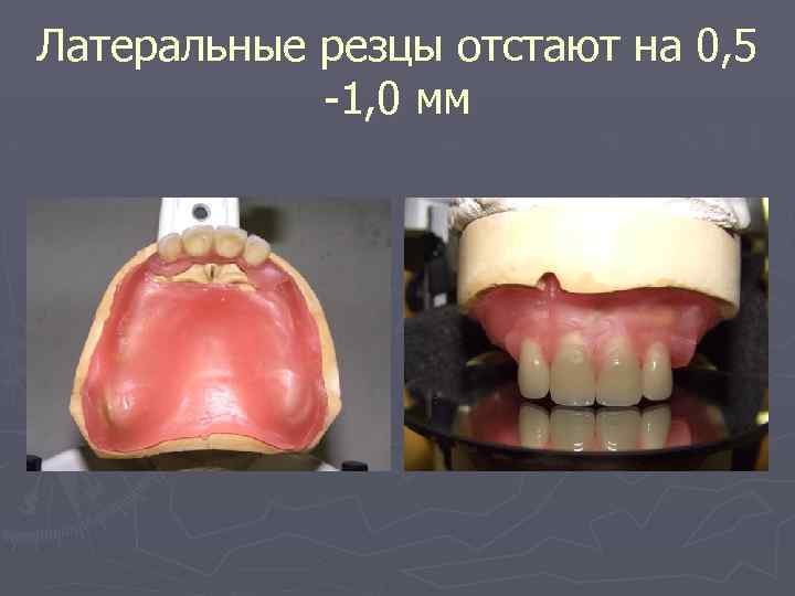Латеральные резцы отстают на 0, 5 -1, 0 мм 