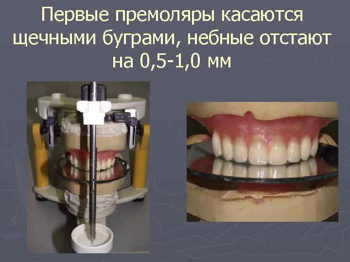 Первые премоляры касаются щечными буграми, небные отстают на 0, 5 -1, 0 мм 