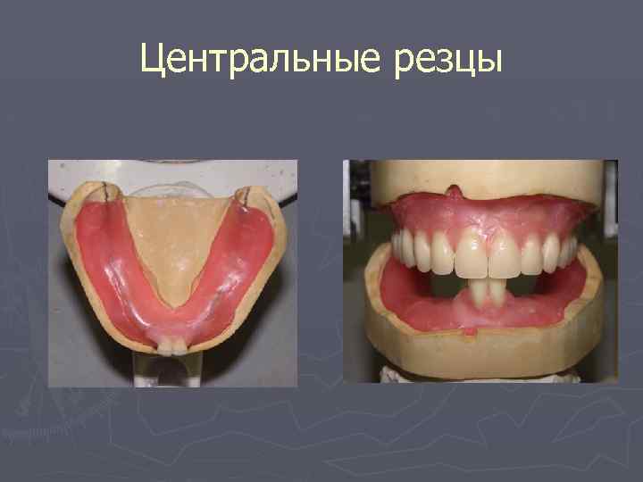 Центральные резцы 