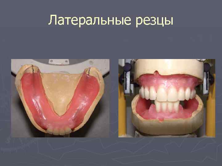 Латеральные резцы 