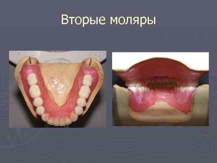 Вторые моляры 