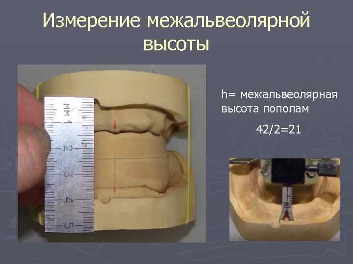 Измерение межальвеолярной высоты h= межальвеолярная высота пополам 42/2=21 