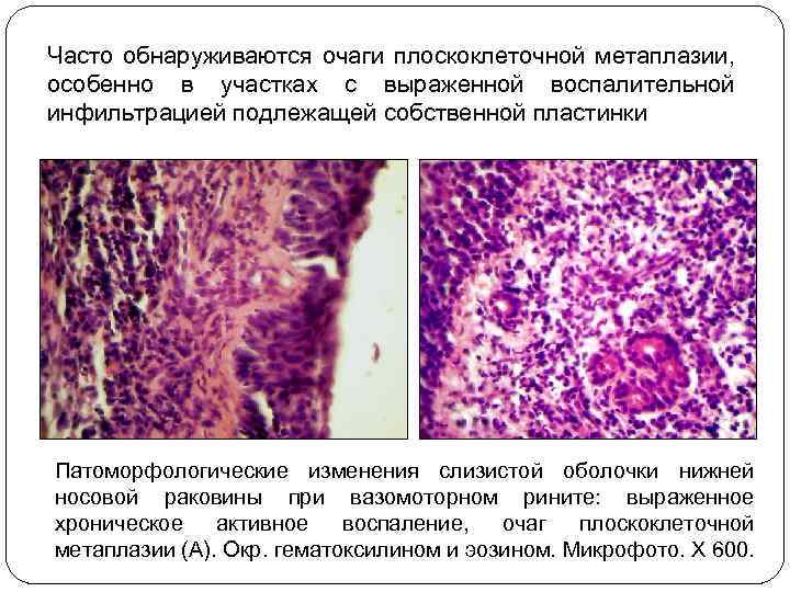 Часто обнаруживаются очаги плоскоклеточной метаплазии, особенно в участках с выраженной воспалительной инфильтрацией подлежащей собственной