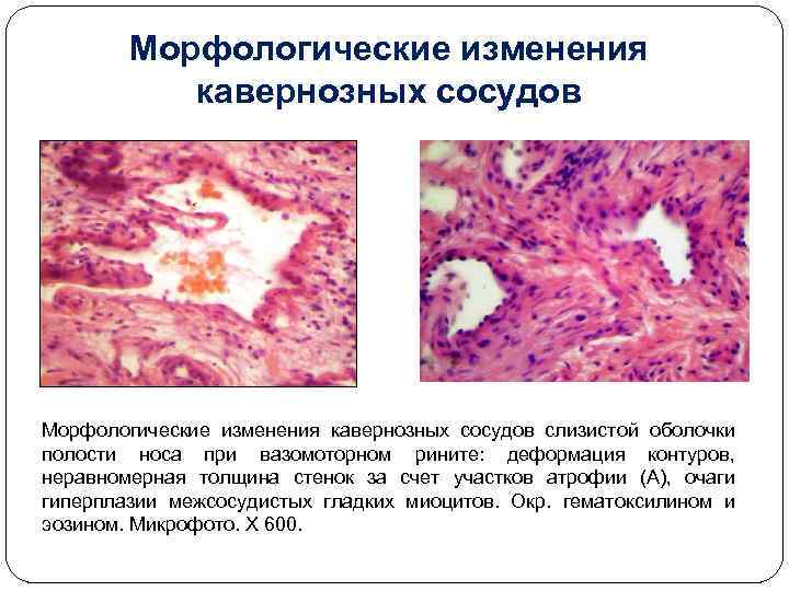 Морфологические изменения кавернозных сосудов слизистой оболочки полости носа при вазомоторном рините: деформация контуров, неравномерная