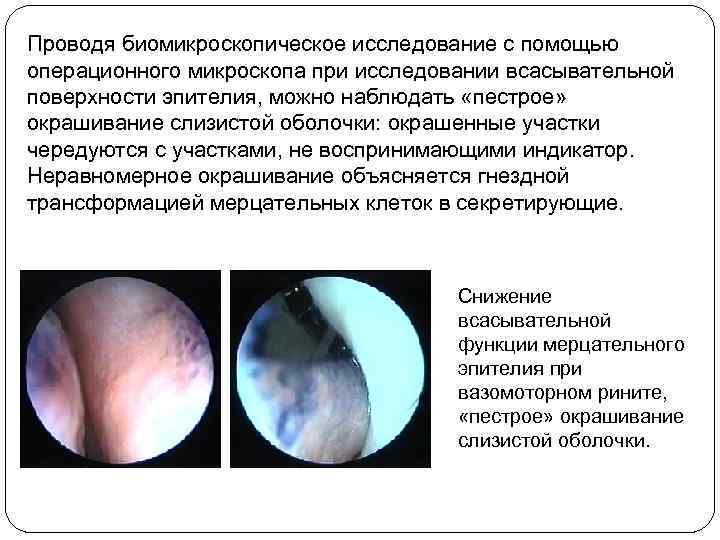 Проводя биомикроскопическое исследование с помощью операционного микроскопа при исследовании всасывательной поверхности эпителия, можно наблюдать
