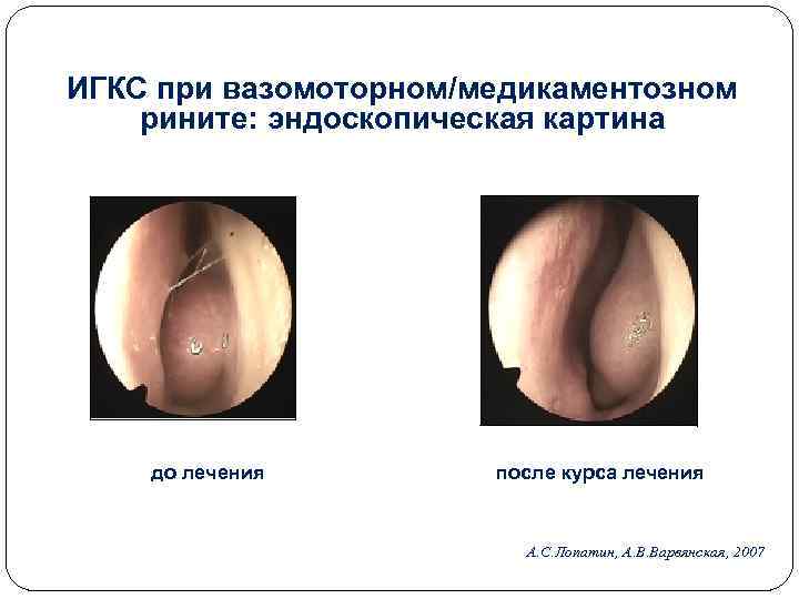 ИГКС при вазомоторном/медикаментозном рините: эндоскопическая картина до лечения после курса лечения А. С. Лопатин,