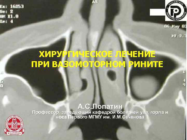 ХИРУРГИЧЕСКОЕ ЛЕЧЕНИЕ ПРИ ВАЗОМОТОРНОМ РИНИТЕ А. С. Лопатин Профессор, заведующий кафедрой болезней уха, горла