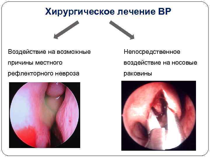 Хирургическое лечение ВР Воздействие на возможные Непосредственное причины местного воздействие на носовые рефлекторного невроза