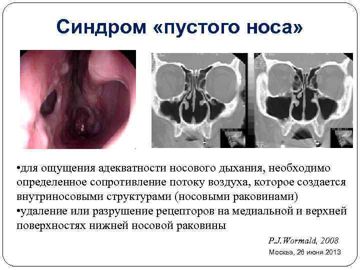 Синдром «пустого носа» • для ощущения адекватности носового дыхания, необходимо определенное сопротивление потоку воздуха,
