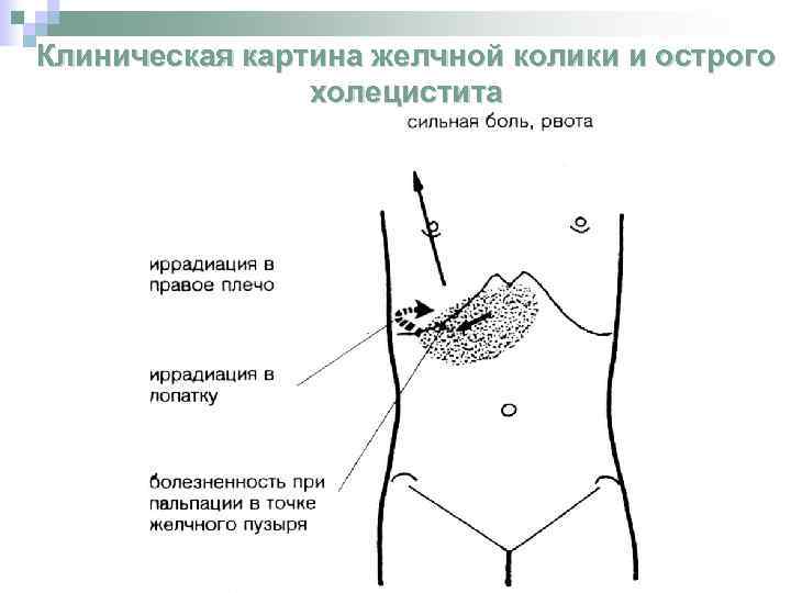 Клиническая картина желчной колики и острого холецистита 