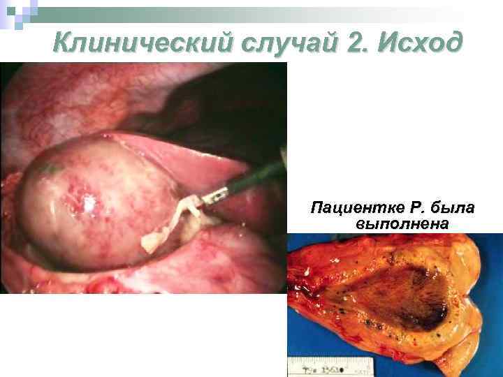 Клинический случай 2. Исход Пациентке Р. была выполнена холецистэктомия. Послеоперационный период протекал гладко. 