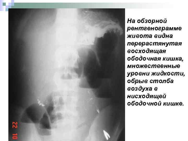 На обзорной рентгенограмме живота видна перерастянутая восходящая ободочная кишка, множественные уровни жидкости, обрыв столба