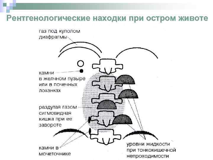 Рентгенологические находки при остром животе 