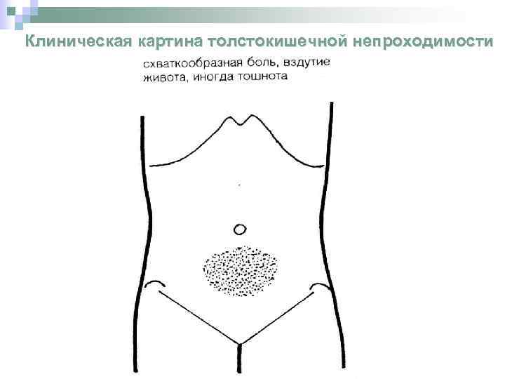 Клиническая картина толстокишечной непроходимости 