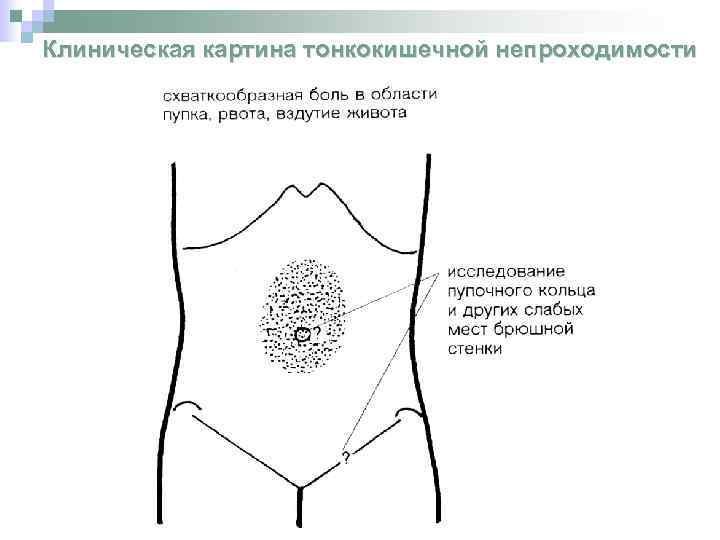 Клиническая картина тонкокишечной непроходимости 