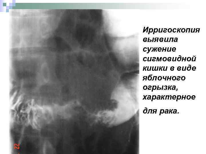 Ирригоскопия выявила сужение сигмовидной кишки в виде яблочного огрызка, характерное для рака. 