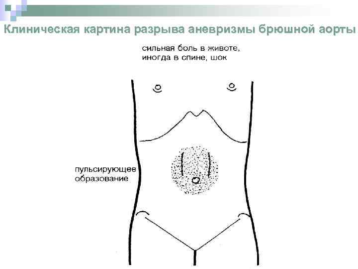 Клиническая картина разрыва аневризмы брюшной аорты 