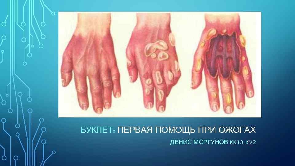 БУКЛЕТ: ПЕРВАЯ ПОМОЩЬ ПРИ ОЖОГАХ ДЕНИС МОРГУНОВ KK 13 -KV 2 