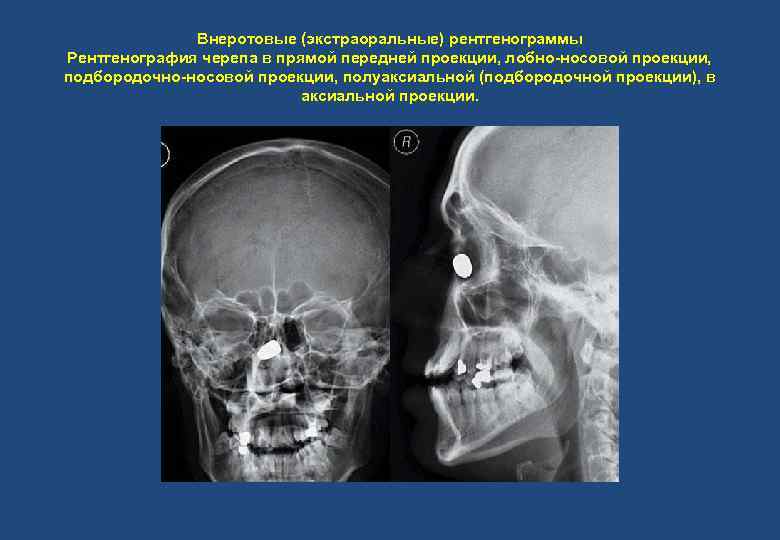 Внеротовые (экстраоральные) рентгенограммы Рентгенография черепа в прямой передней проекции, лобно-носовой проекции, подбородочно-носовой проекции, полуаксиальной