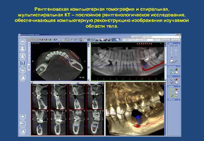 Спиральная компьютерная томография что это