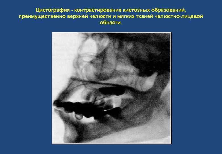 Цистография - контрастирование кистозных образований, преимущественно верхней челюсти и мягких тканей челюстно-лицевой области. 