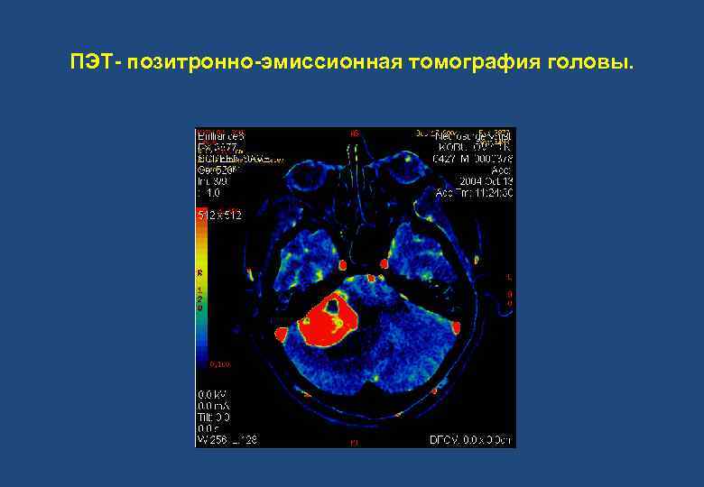 ПЭТ- позитронно-эмиссионная томография головы. 