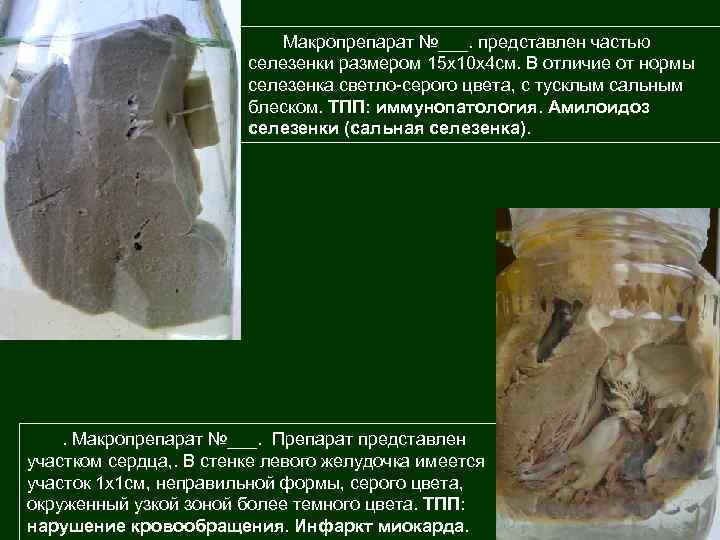 Макропрепарат №___. представлен частью селезенки размером 15 х10 х4 см. В отличие от нормы