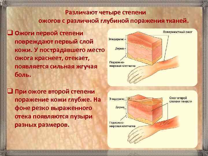  Pазличают четыре степени ожогов с различной глубиной поражения тканей. q Ожоги первой степени