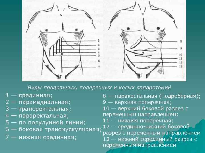 Виды продольных, поперечных и косых лапаротомий 1 — срединная; 8 — паракостальная (подреберная); 9