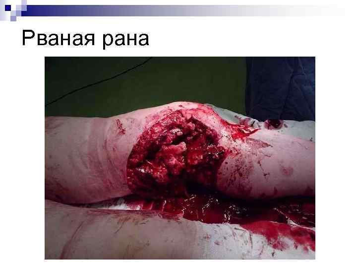 Рваная рана 