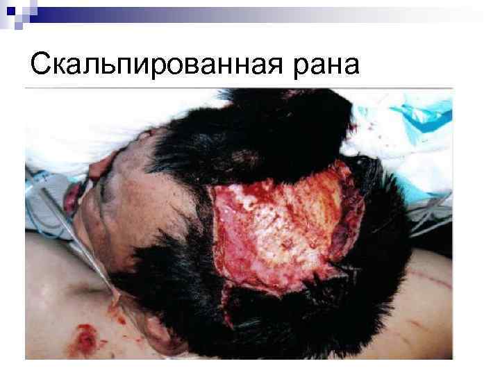 Скальпированная рана 