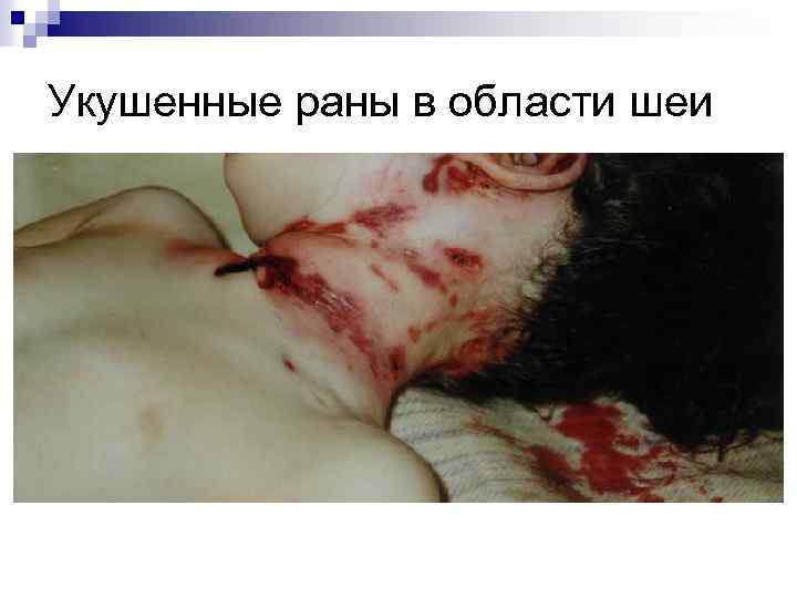 Укушенные раны в области шеи 