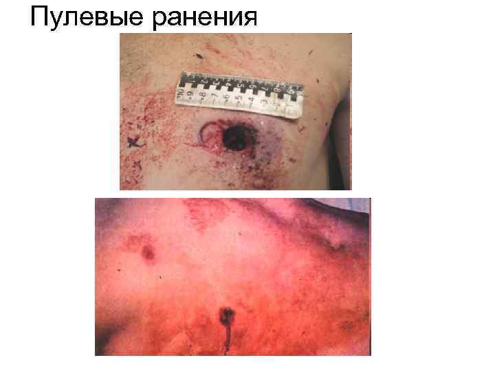 Пулевые ранения 