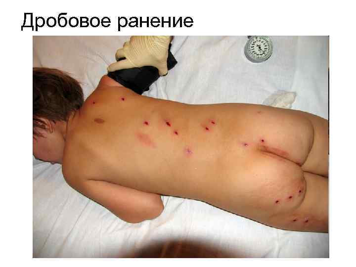 Дробовое ранение 