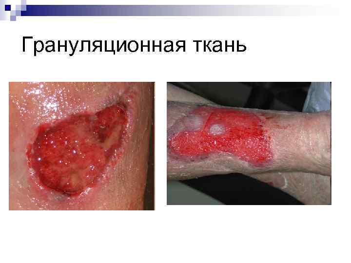 Грануляционная ткань 