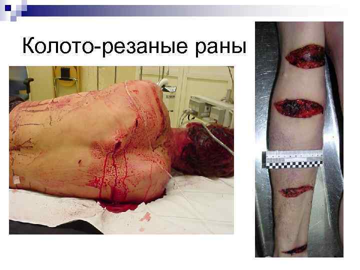 Колото-резаные раны 