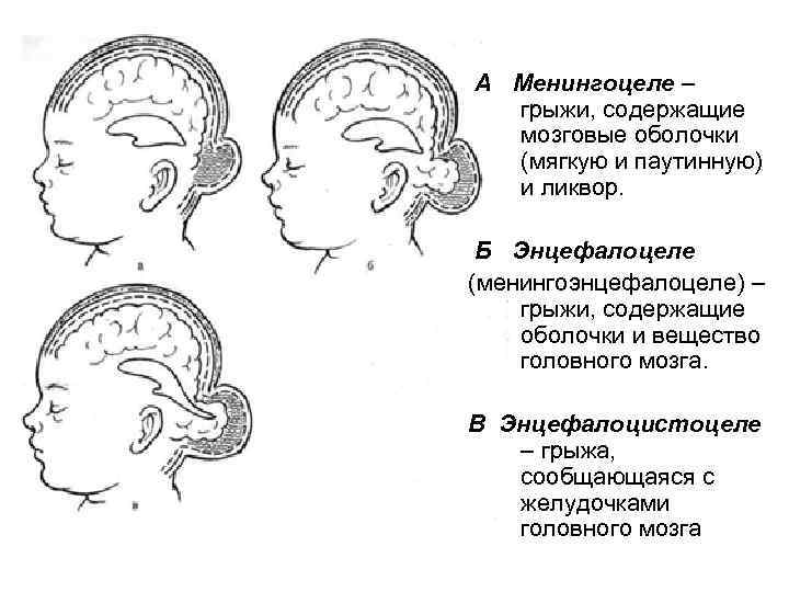 А Менингоцеле – грыжи, содержащие мозговые оболочки (мягкую и паутинную) и ликвор. Б Энцефалоцеле