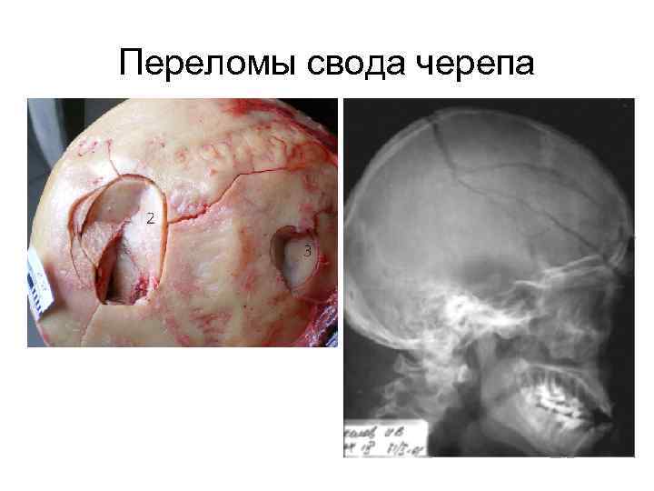 Переломы свода черепа 