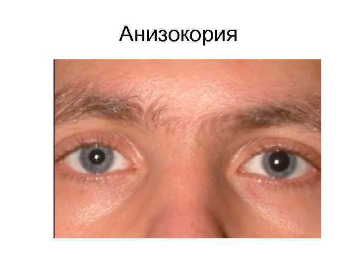 Анизокория 