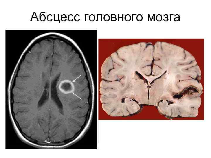 Абсцесс головного мозга 