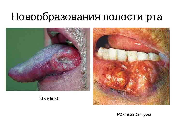 Новообразования полости рта Рак языка Рак нижней губы 