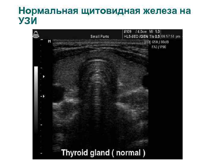 Нормальная щитовидная железа на УЗИ 