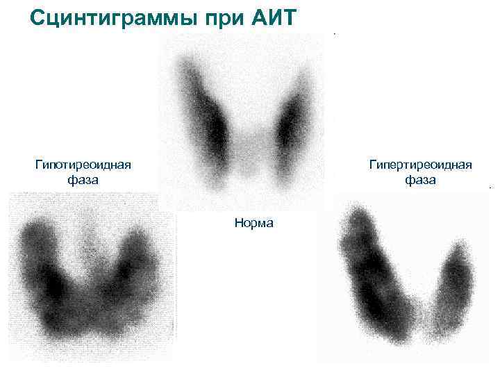 Сцинтиграммы при АИТ Гипотиреоидная фаза Гипертиреоидная фаза Норма 
