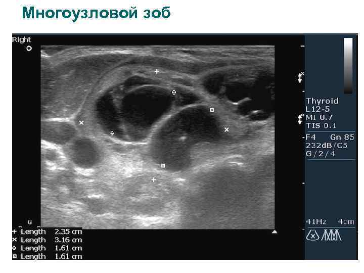 Многоузловой зоб 