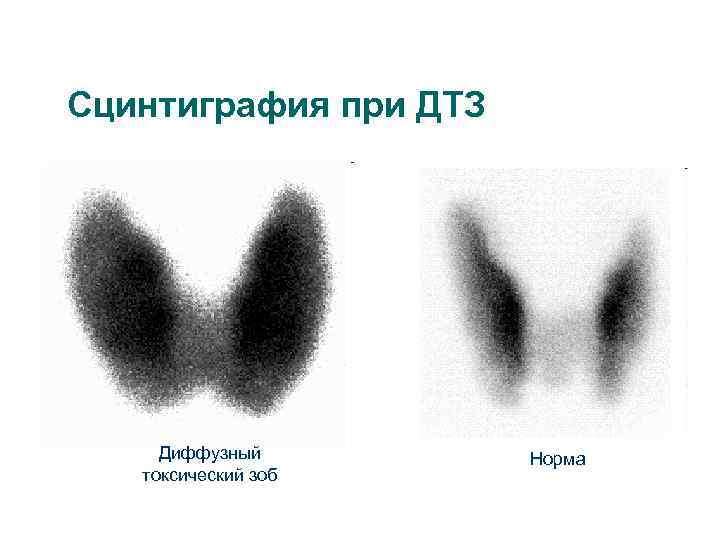 Сцинтиграфия при ДТЗ Диффузный токсический зоб Норма 